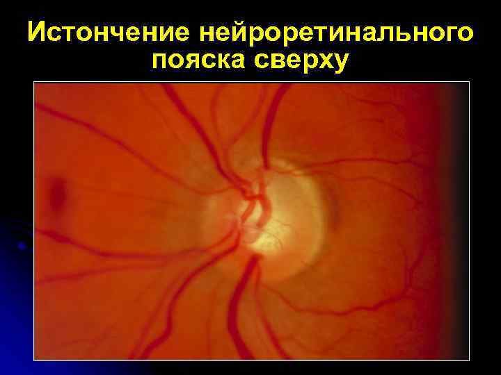 Истончение нейроретинального пояска сверху 