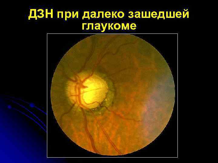 ДЗН при далеко зашедшей глаукоме 