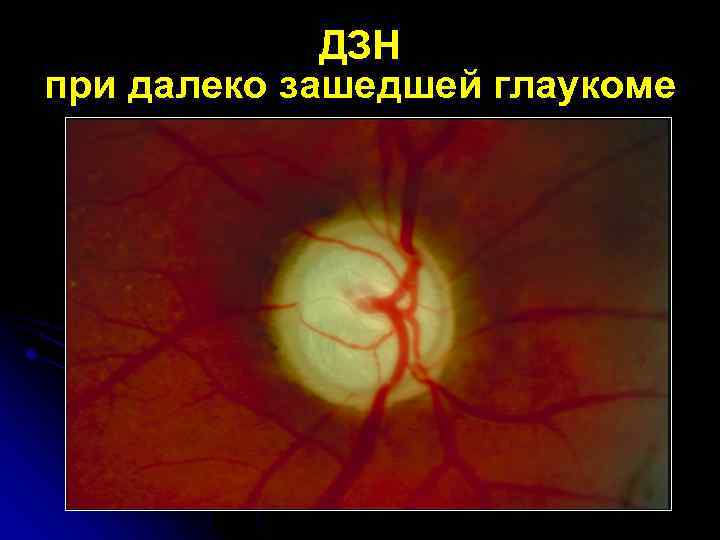 ДЗН при далеко зашедшей глаукоме 