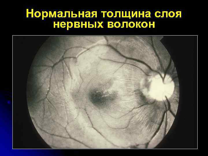 Нормальная толщина слоя нервных волокон 
