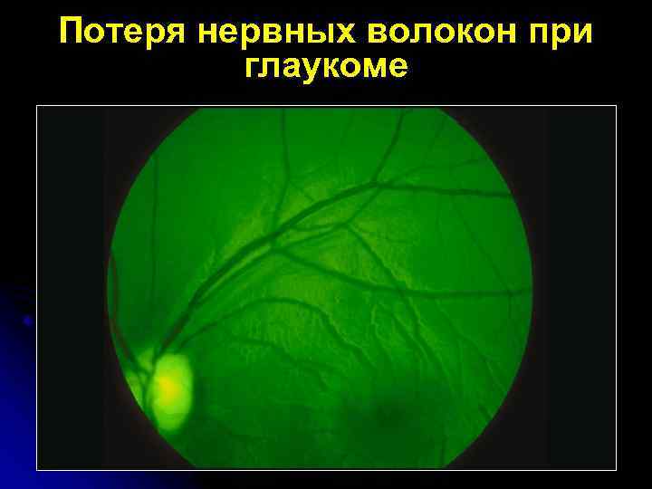 Потеря нервных волокон при глаукоме 