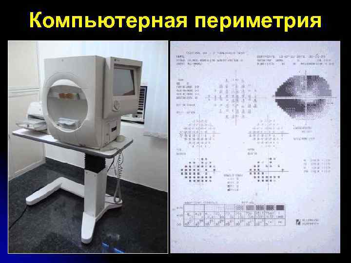Компьютерная периметрия 