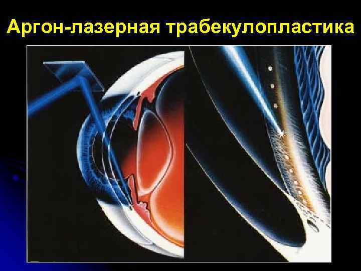 Аргон-лазерная трабекулопластика 