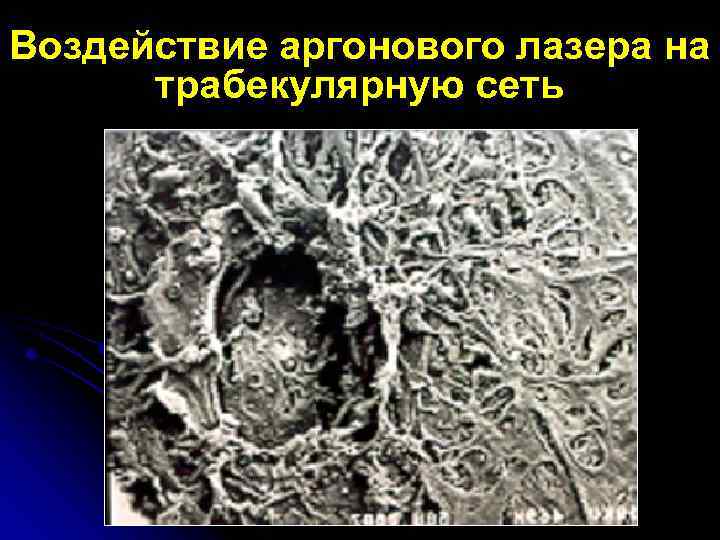 Воздействие аргонового лазера на трабекулярную сеть 