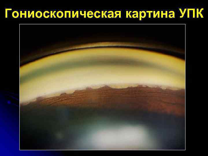 Гониоскопическая картина УПК 