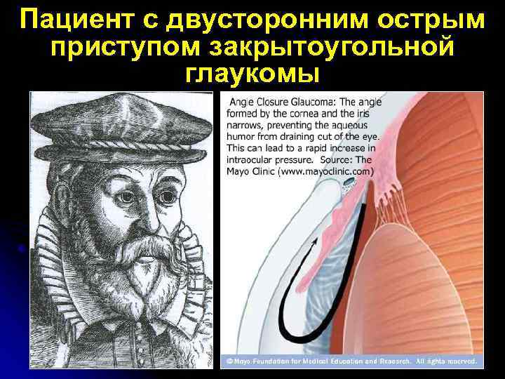 Пациент с двусторонним острым приступом закрытоугольной глаукомы 