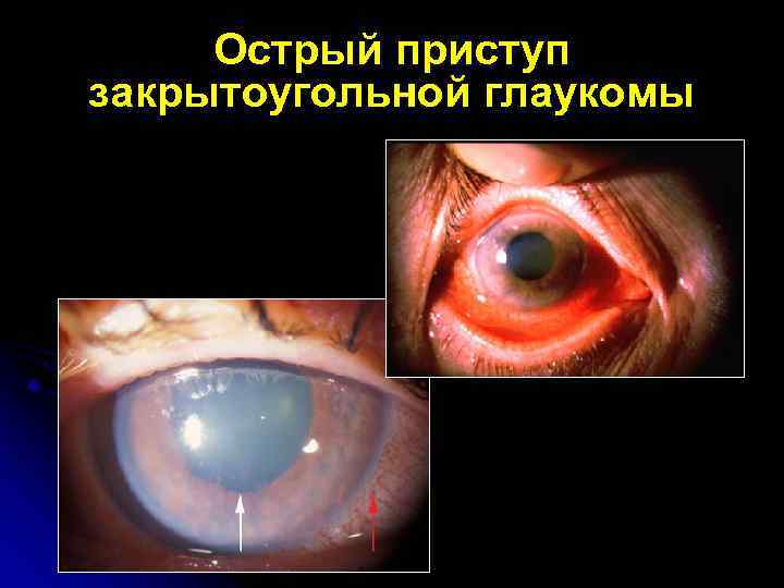 Острый приступ закрытоугольной глаукомы 