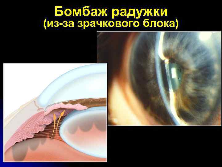 Бомбаж радужки (из-за зрачкового блока) 