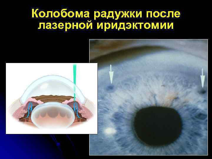Колобома радужки после лазерной иридэктомии 