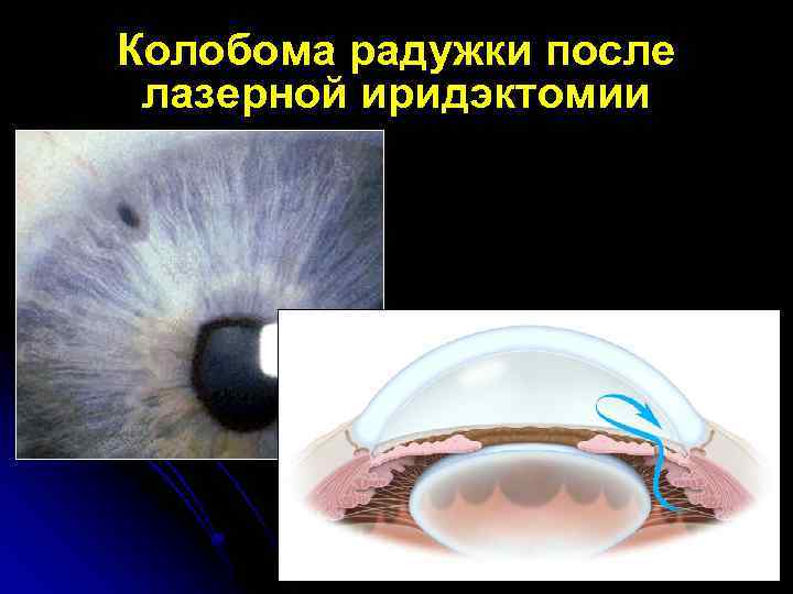 Колобома радужки после лазерной иридэктомии 