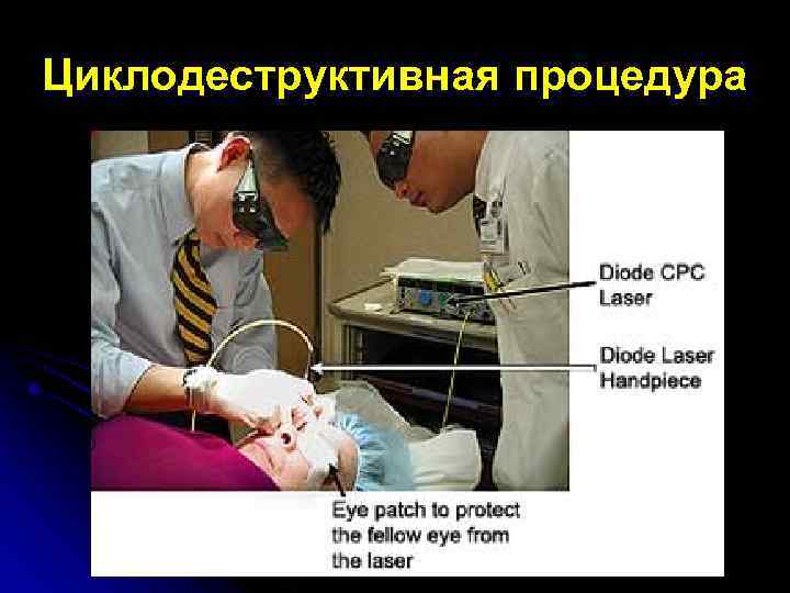 Циклодеструктивная процедура 