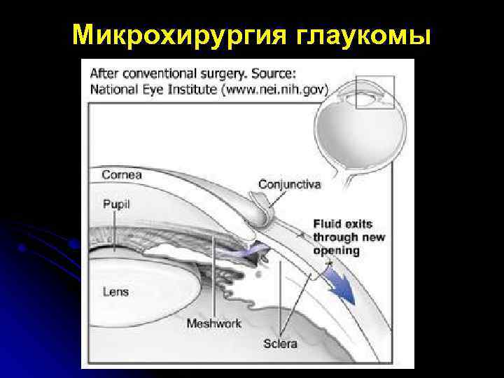 Микрохирургия глаукомы 
