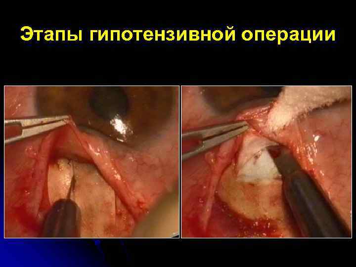 Этапы гипотензивной операции 