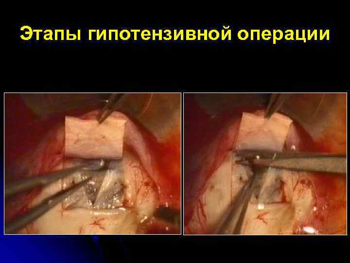 Этапы гипотензивной операции 