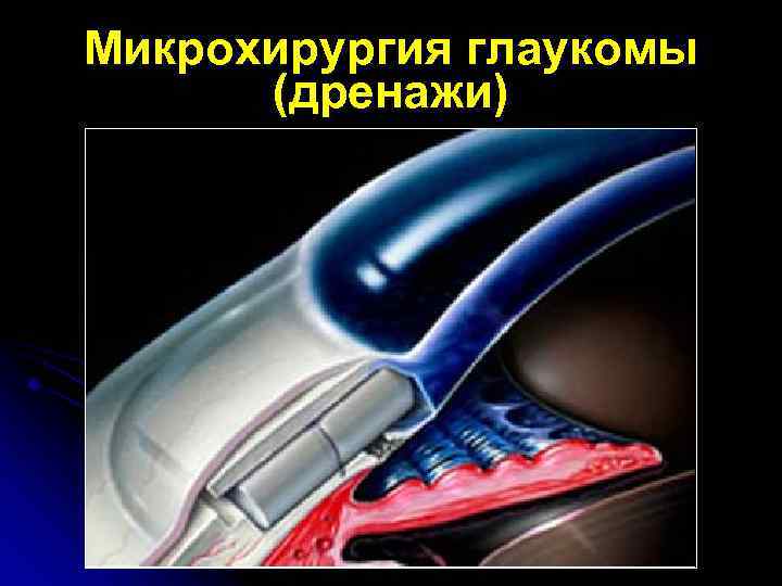 Микрохирургия глаукомы (дренажи) 