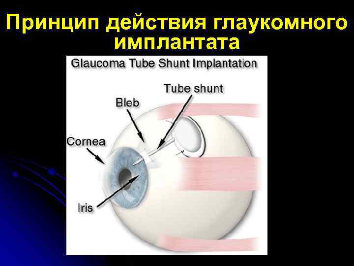 Принцип действия глаукомного имплантата 