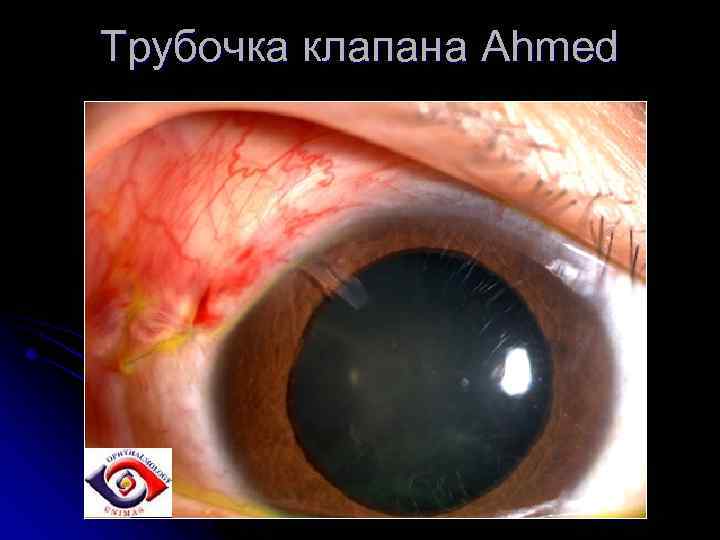 Трубочка клапана Ahmed 