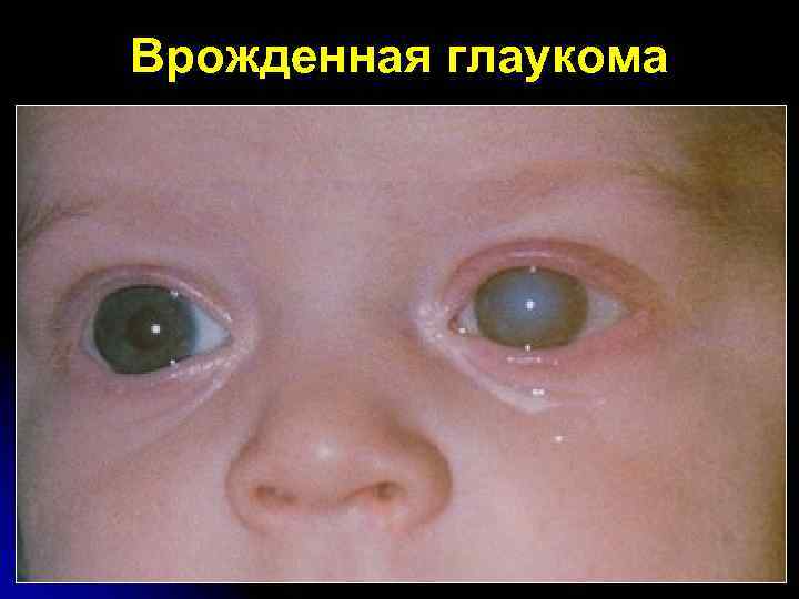 Врожденная глаукома 