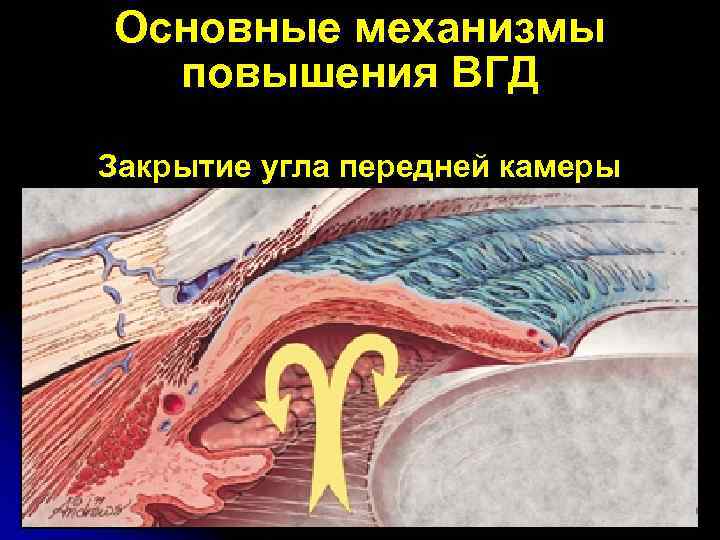 Основные механизмы повышения ВГД Закрытие угла передней камеры 