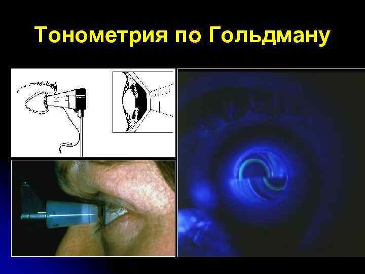 Тонометрия по Гольдману 