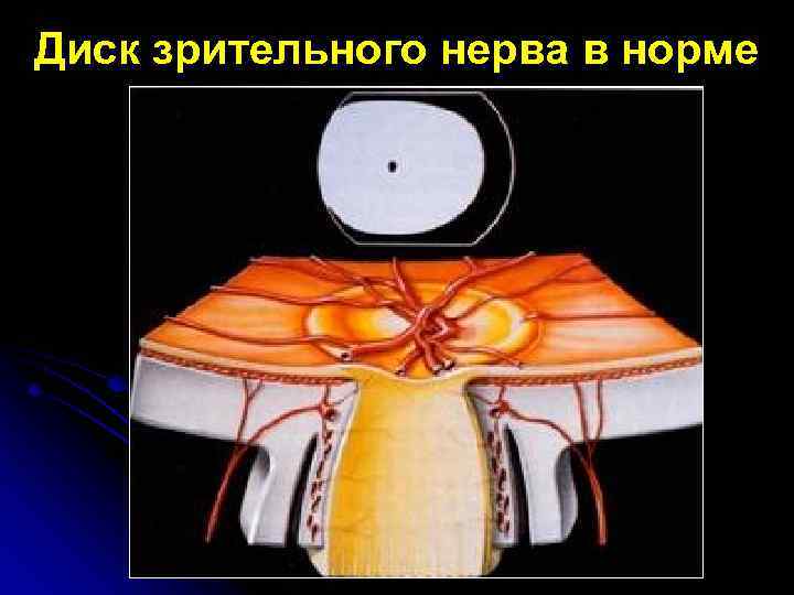 Диск зрительного нерва в норме 