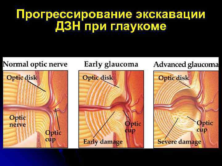 Прогрессирование экскавации ДЗН при глаукоме 