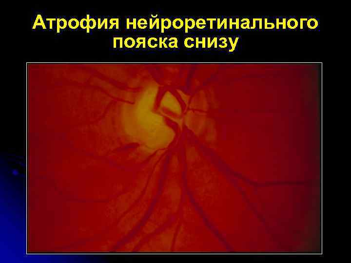 Атрофия нейроретинального пояска снизу 