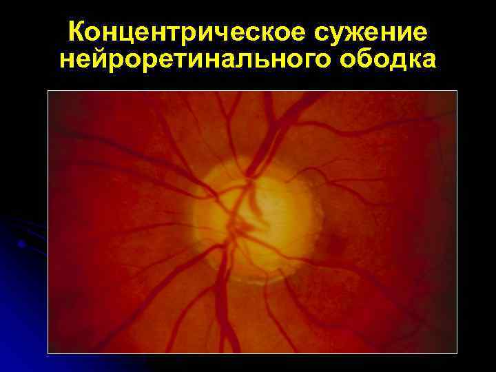 Концентрическое сужение нейроретинального ободка 