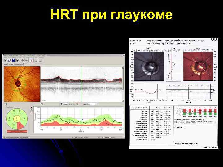 HRT при глаукоме 