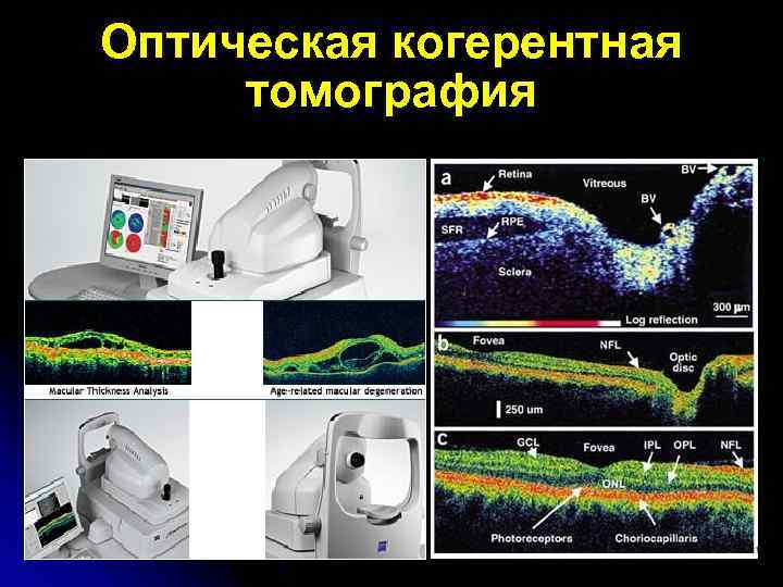 Оптическая когерентная томография 