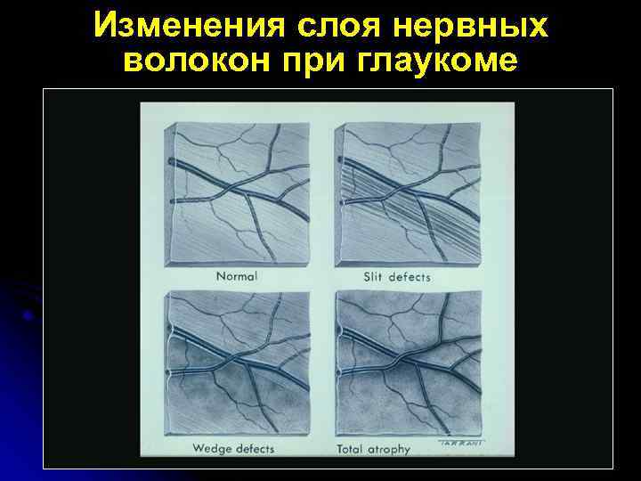 Изменения слоя нервных волокон при глаукоме 