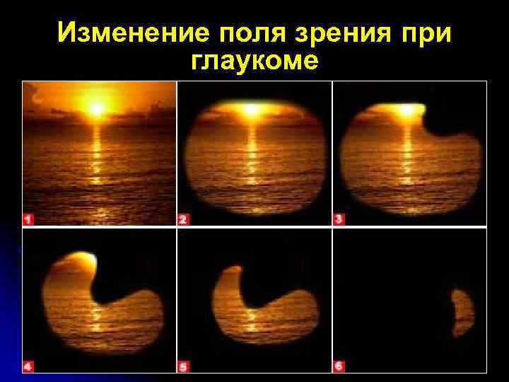 Изменение поля зрения при глаукоме 