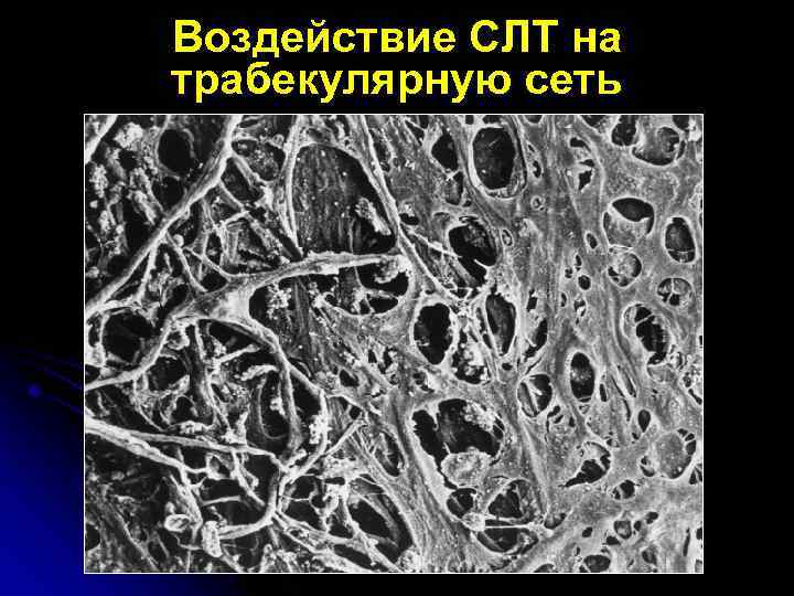 Воздействие СЛТ на трабекулярную сеть 