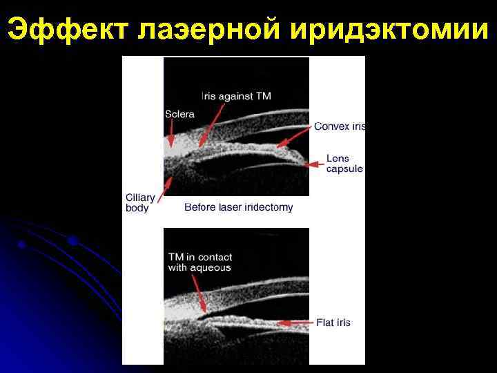 Эффект лаэерной иридэктомии 