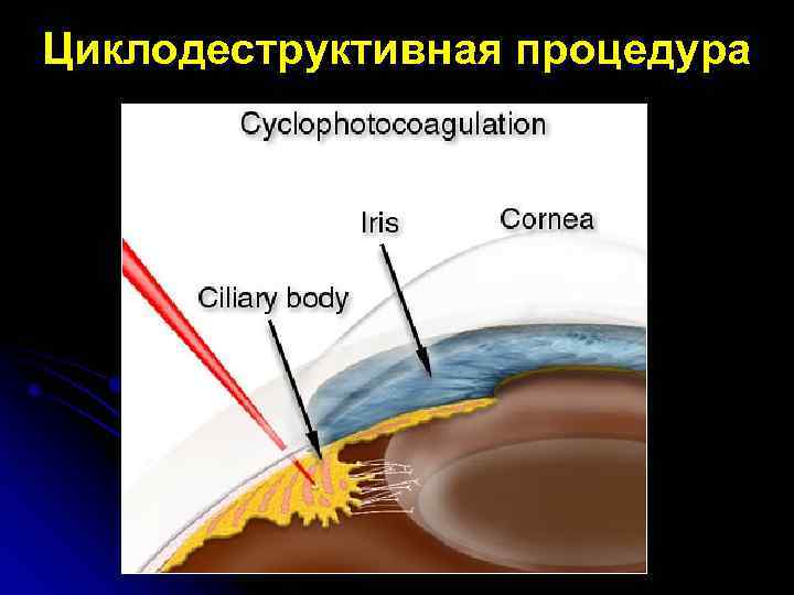 Циклодеструктивная процедура 