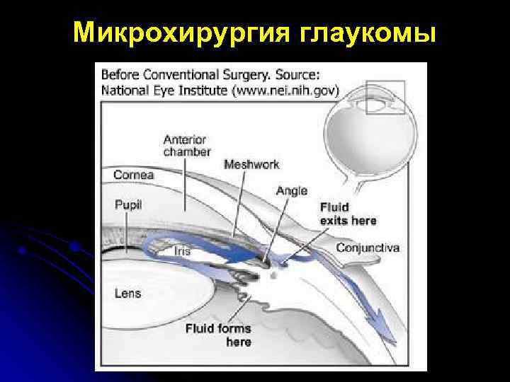 Микрохирургия глаукомы 
