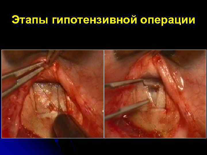 Этапы гипотензивной операции 