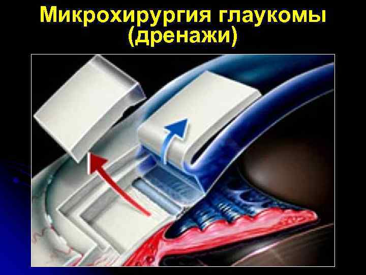 Микрохирургия глаукомы (дренажи) 