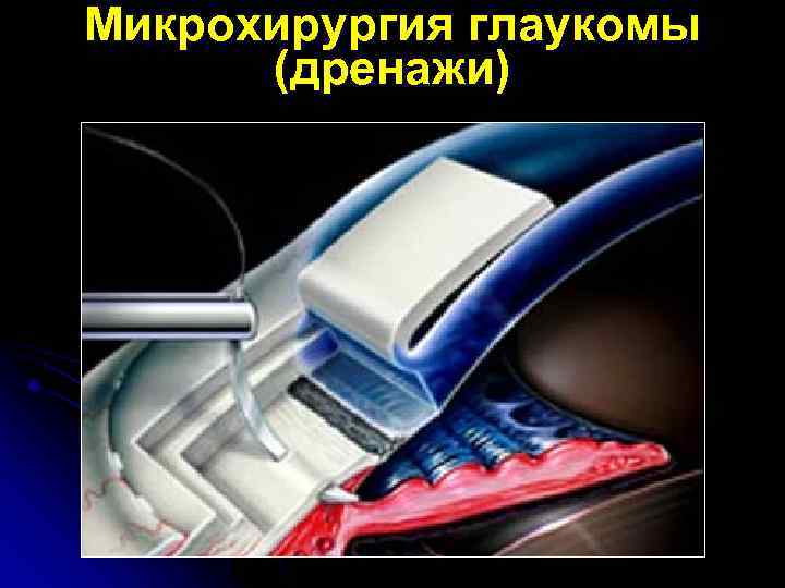 Микрохирургия глаукомы (дренажи) 