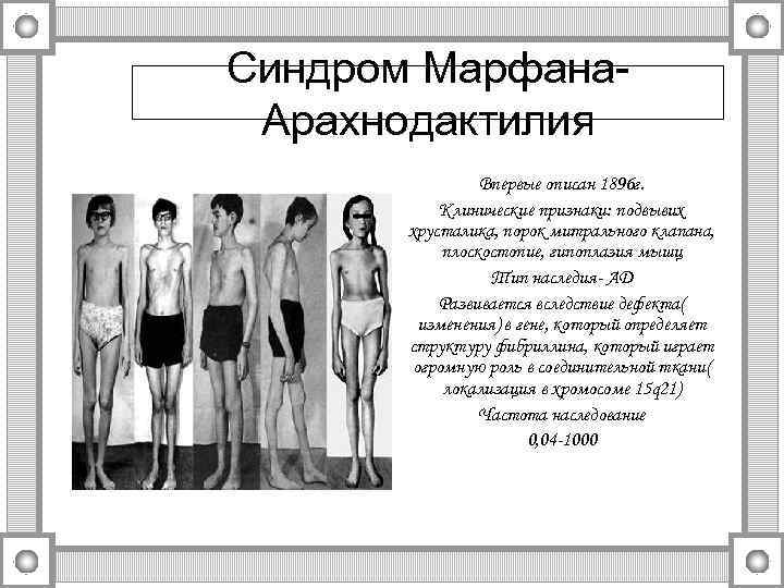 Синдром Марфана- Арахнодактилия   Впервые описан 1896 г.   Клинические признаки: подвывих