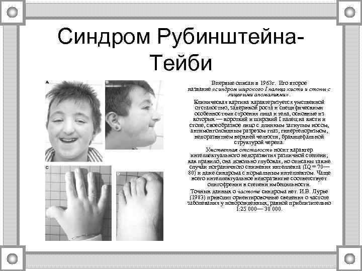 Синдром Рубинштейна-   Тейби     Впервые описан в 1963 г.