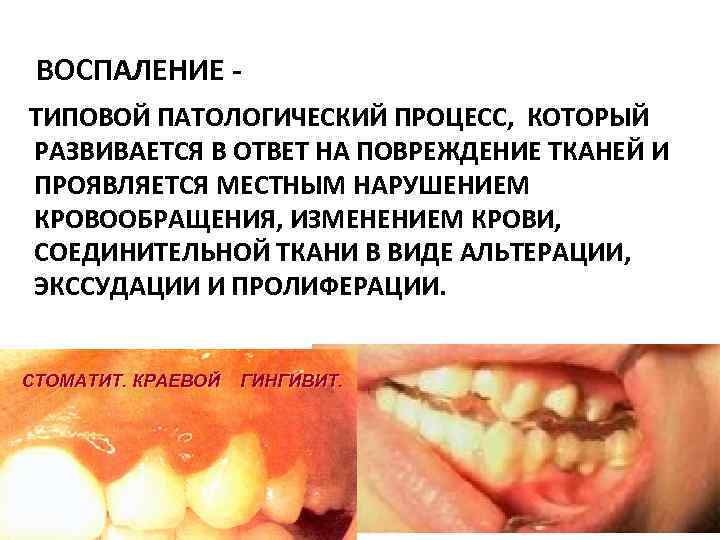  ВОСПАЛЕНИЕ - ТИПОВОЙ ПАТОЛОГИЧЕСКИЙ ПРОЦЕСС, КОТОРЫЙ РАЗВИВАЕТСЯ В ОТВЕТ НА ПОВРЕЖДЕНИЕ ТКАНЕЙ И