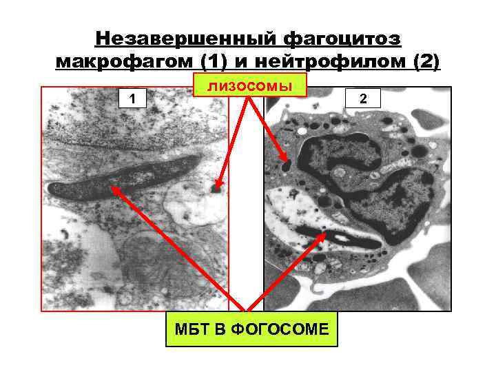 Незавершенный фагоцитоз макрофагом (1) и нейтрофилом (2) лизосомы 1 Незавершенный фагоцитоз макрофагом (1) и нейтрофилом (2) лизосомы 1