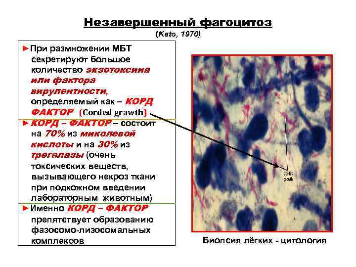Незавершенный фагоцитоз (Kato, 1970) ►При размножении МБТ Незавершенный фагоцитоз (Kato, 1970) ►При размножении МБТ