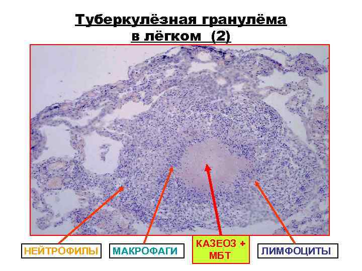 Туберкулёзная гранулёма в лёгком (2) КАЗЕОЗ + Туберкулёзная гранулёма в лёгком (2) КАЗЕОЗ +