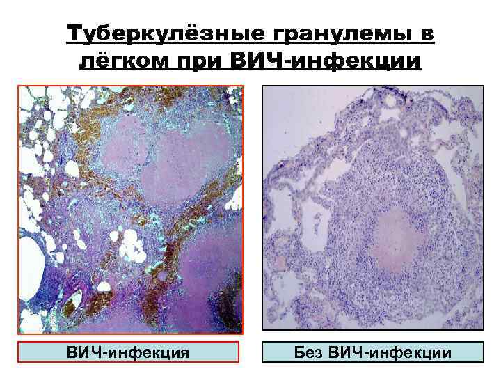 Туберкулёзные гранулемы в лёгком при ВИЧ-инфекция Без ВИЧ-инфекции Туберкулёзные гранулемы в лёгком при ВИЧ-инфекция Без ВИЧ-инфекции