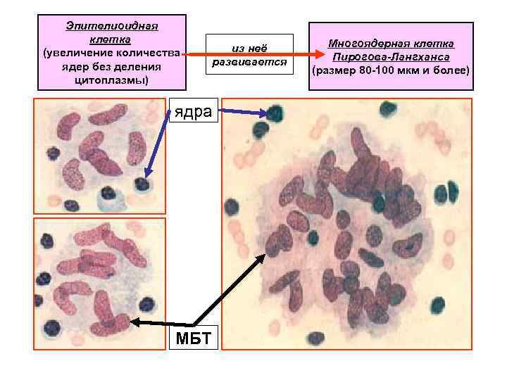 Эпителиоидная клетка Многоядерная клетка (увеличение количества Эпителиоидная клетка Многоядерная клетка (увеличение количества