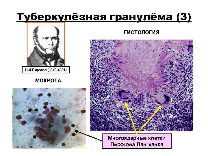 Туберкулёзная гранулёма (3) ГИСТОЛОГИЯ Н. И. Пирогов (1810 Туберкулёзная гранулёма (3) ГИСТОЛОГИЯ Н. И. Пирогов (1810