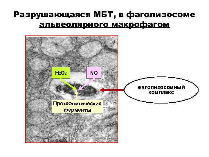 Разрушающаяся МБТ, в фаголизосоме альвеолярного макрофагом Н 2 О 2 NО Разрушающаяся МБТ, в фаголизосоме альвеолярного макрофагом Н 2 О 2 NО
