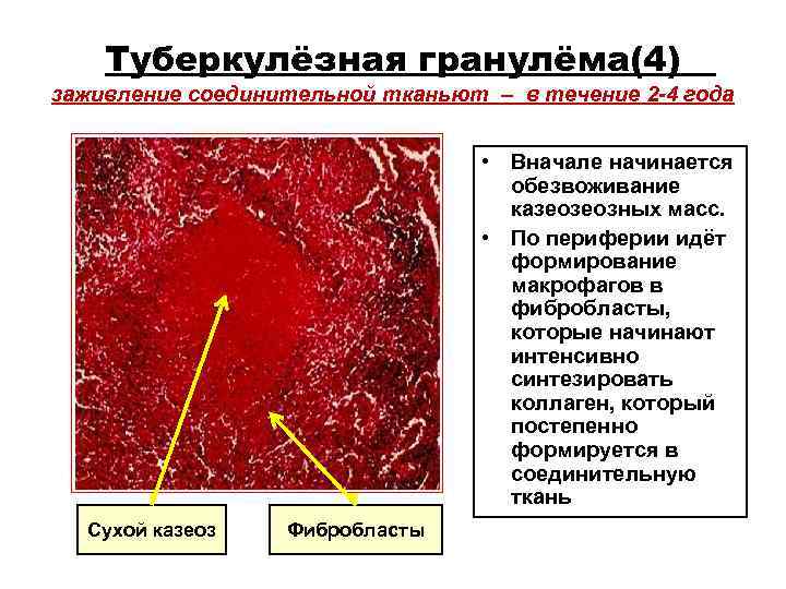 Туберкулёзная гранулёма(4) заживление соединительной тканьют – в течение 2 -4 года Туберкулёзная гранулёма(4) заживление соединительной тканьют – в течение 2 -4 года